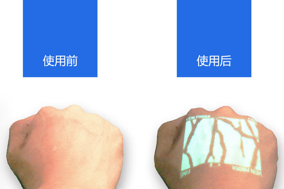 VeinSight静脉显像仪/静脉显示仪/血管显像仪/使用前后对比